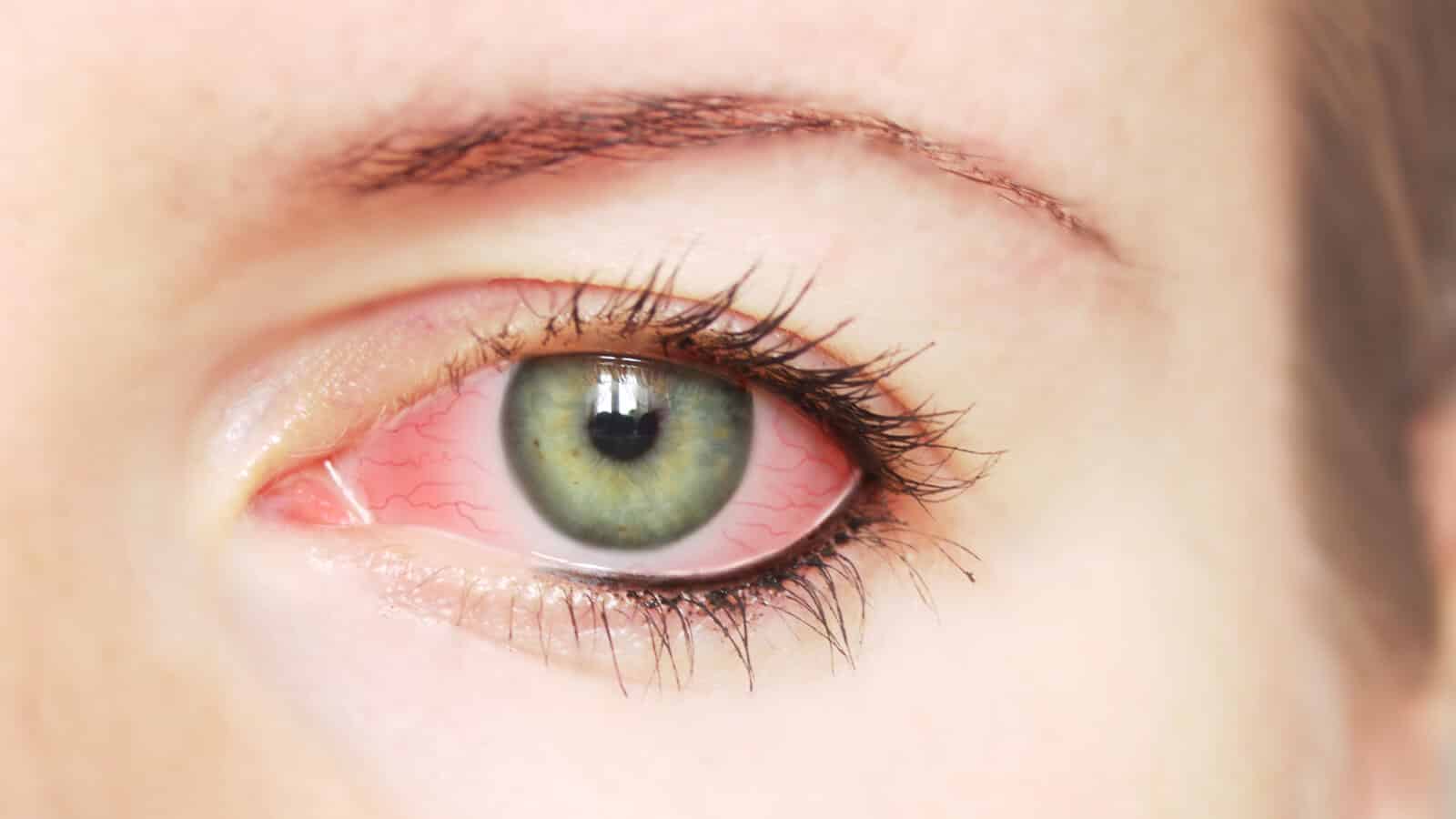 علاج التهاب الملتحمة احمرار العين مجلة نقطة العلمية