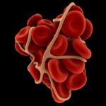 BloodClot نحو الكشف عن تجلط الدم عن طريق تحليل البول مجلة نقطة العلمية