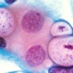 Pap smear showing clamydia in the vacuoles 500x HE e1408949426275 مرض الكلاميديا مجلة نقطة العلمية