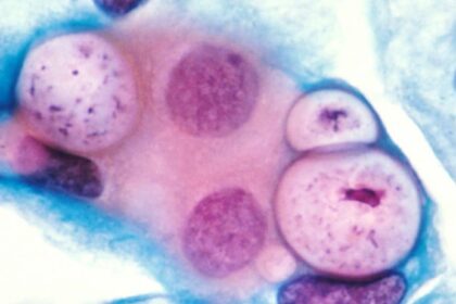 Pap smear showing clamydia in the vacuoles 500x HE e1408949426275 مرض الكلاميديا مجلة نقطة العلمية