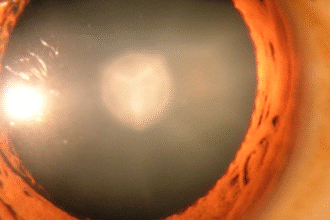 Cataract in human eye e1412807448236 فيتامين E والسيلينيوم لا يمنعا الاصابة بماء العين الأبيض مجلة نقطة العلمية