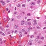 Oligodendroglioma1 high mag1 e1414718034748 أورام المخ المختلفة تنبع من ذات الخلايا مجلة نقطة العلمية