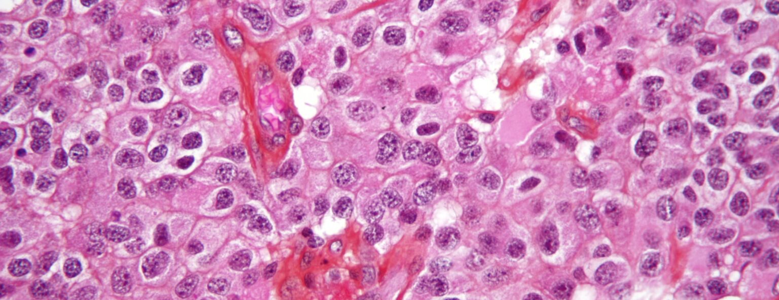 Oligodendroglioma1 high mag1 e1414718034748 أورام المخ المختلفة تنبع من ذات الخلايا مجلة نقطة العلمية