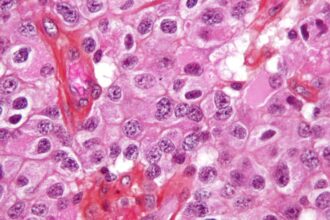 Oligodendroglioma1 high mag1 e1414718034748 أورام المخ المختلفة تنبع من ذات الخلايا مجلة نقطة العلمية