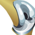 22. new knee copy e1417260510976 فكر جيداً قبل الخضوع لعملية تبديل مفصل الركبة مجلة نقطة العلمية