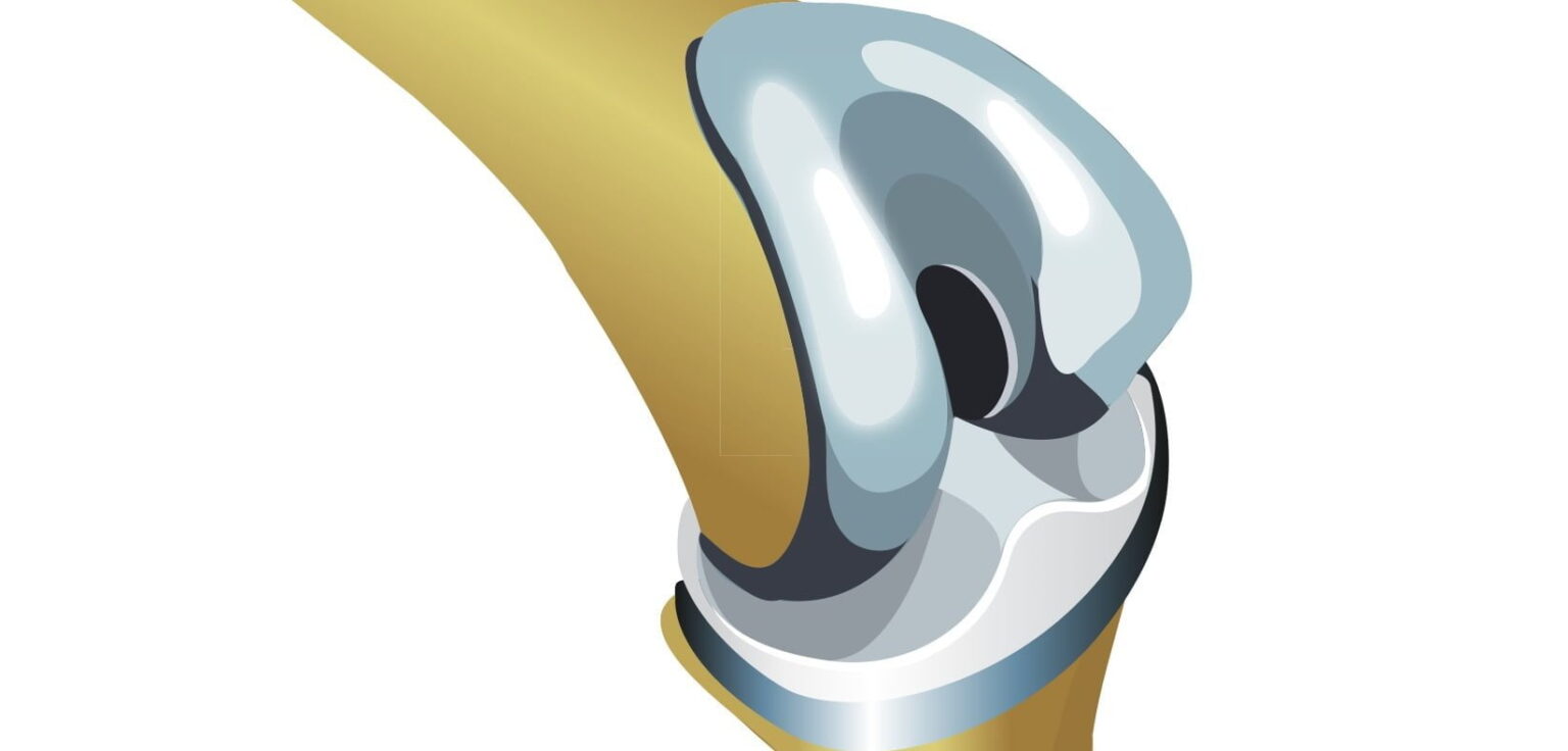 22. new knee copy e1417260510976 فكر جيداً قبل الخضوع لعملية تبديل مفصل الركبة مجلة نقطة العلمية