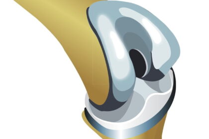 22. new knee copy e1417260510976 فكر جيداً قبل الخضوع لعملية تبديل مفصل الركبة مجلة نقطة العلمية