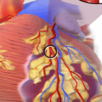 Blausen 0463 HeartAttack e1417301436206 احتشاء العضلة القلبية مجلة نقطة العلمية