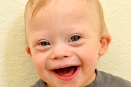 baby down syndrome face boy smiling 9 e1415324340838 المصابون بمتلازمة داون أكثر عرضة للاصابة بالزهايمر مجلة نقطة العلمية