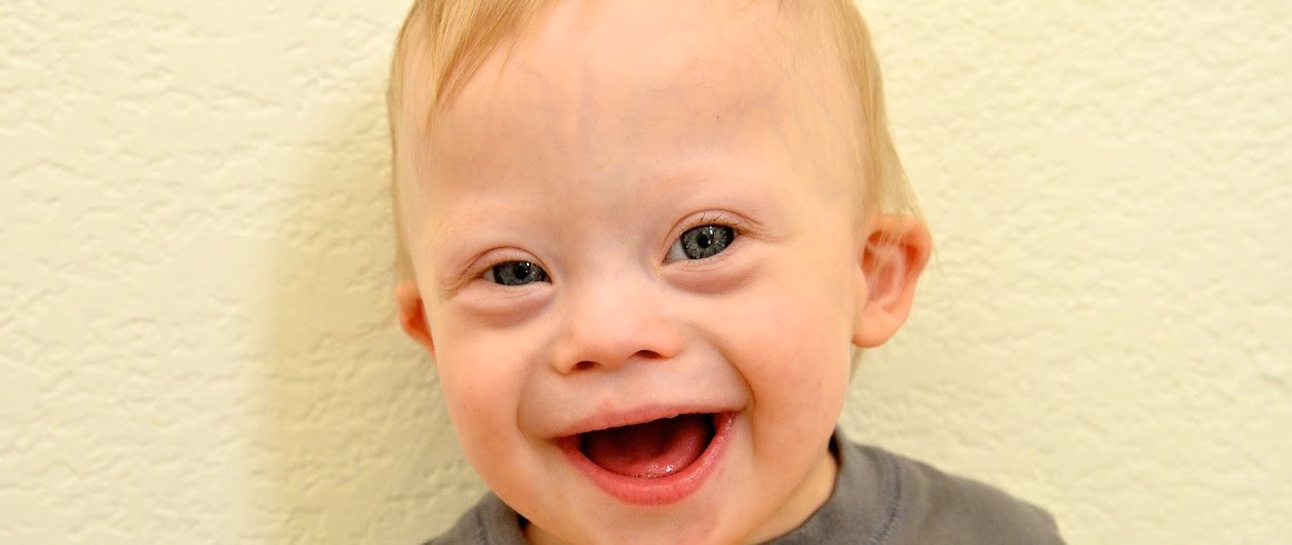 Baby Down Syndrome Face Boy Smiling 9 E1415324340838 مجلة نقطة العلمية