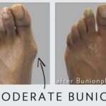 2014 11 19 walkingafterbunionsurgeryny e1417652614992 وداعا للجبيرة والعكازات مجلة نقطة العلمية