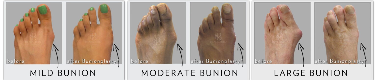 2014 11 19 walkingafterbunionsurgeryny e1417652614992 وداعا للجبيرة والعكازات مجلة نقطة العلمية