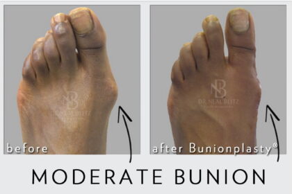 2014 11 19 walkingafterbunionsurgeryny e1417652614992 وداعا للجبيرة والعكازات مجلة نقطة العلمية