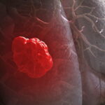 web lung cancer RF gettyc e1417912109759 فحص للمدخنين للتنبيه قبل الاصابة بالسرطان مجلة نقطة العلمية