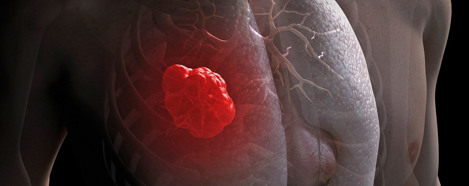 web lung cancer RF gettyc e1417912109759 فحص للمدخنين للتنبيه قبل الاصابة بالسرطان مجلة نقطة العلمية