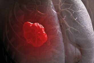 web lung cancer RF gettyc e1417912109759 فحص للمدخنين للتنبيه قبل الاصابة بالسرطان مجلة نقطة العلمية