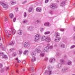 Oligodendroglioma1 high mag e1422819141813 أسباب الإصابة بمرض السرطان مجلة نقطة العلمية