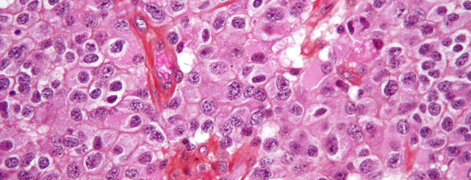 Oligodendroglioma1 high mag e1422819141813 أسباب الإصابة بمرض السرطان مجلة نقطة العلمية