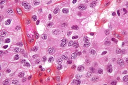 Oligodendroglioma1 high mag e1422819141813 أسباب الإصابة بمرض السرطان مجلة نقطة العلمية