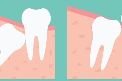 wisdom teeth extraction vancouver e1424728138501 هل يجب اقتلاع أضراس العقل؟ مجلة نقطة العلمية