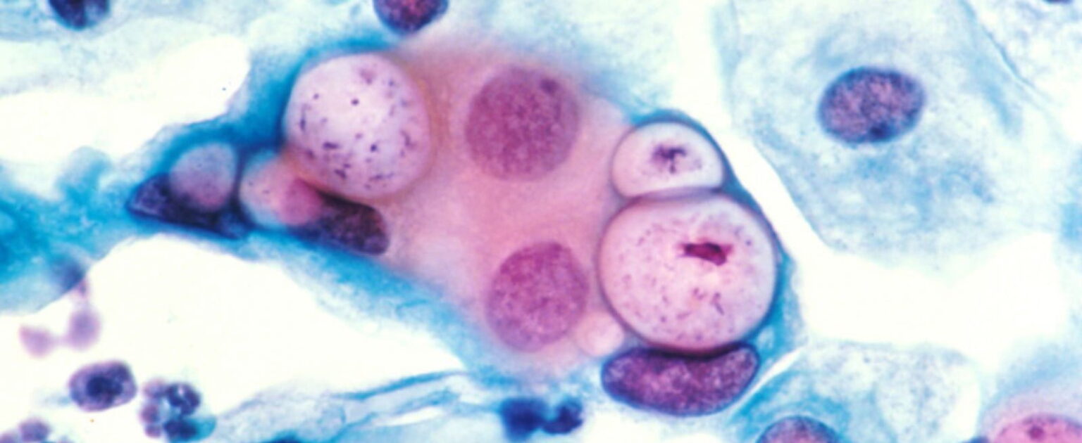 3360002123 e27d75a2f8 o.0.0 e1433881880565 هل يجب على النساء إجراء فحص سرطان عنق الرحم سنوياً ؟ مجلة نقطة العلمية