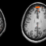 Schizophrenia fMRI working memory e1435184087728 اختلال كيميائي في الدماغ هو المسبب الأساسي لمرض الفصام مجلة نقطة العلمية