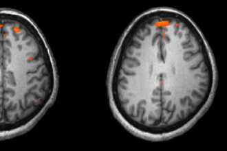 Schizophrenia fMRI working memory e1435184087728 اختلال كيميائي في الدماغ هو المسبب الأساسي لمرض الفصام مجلة نقطة العلمية