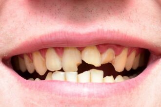 o YELLOW TEETH facebook كيف تتحول الأسنان إلى اللون الأصفر مجلة نقطة العلمية