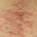 eczema e1447055895810 كيف يمكن علاج الأكزيما بطريقة طبيعية مجلة نقطة العلمية
