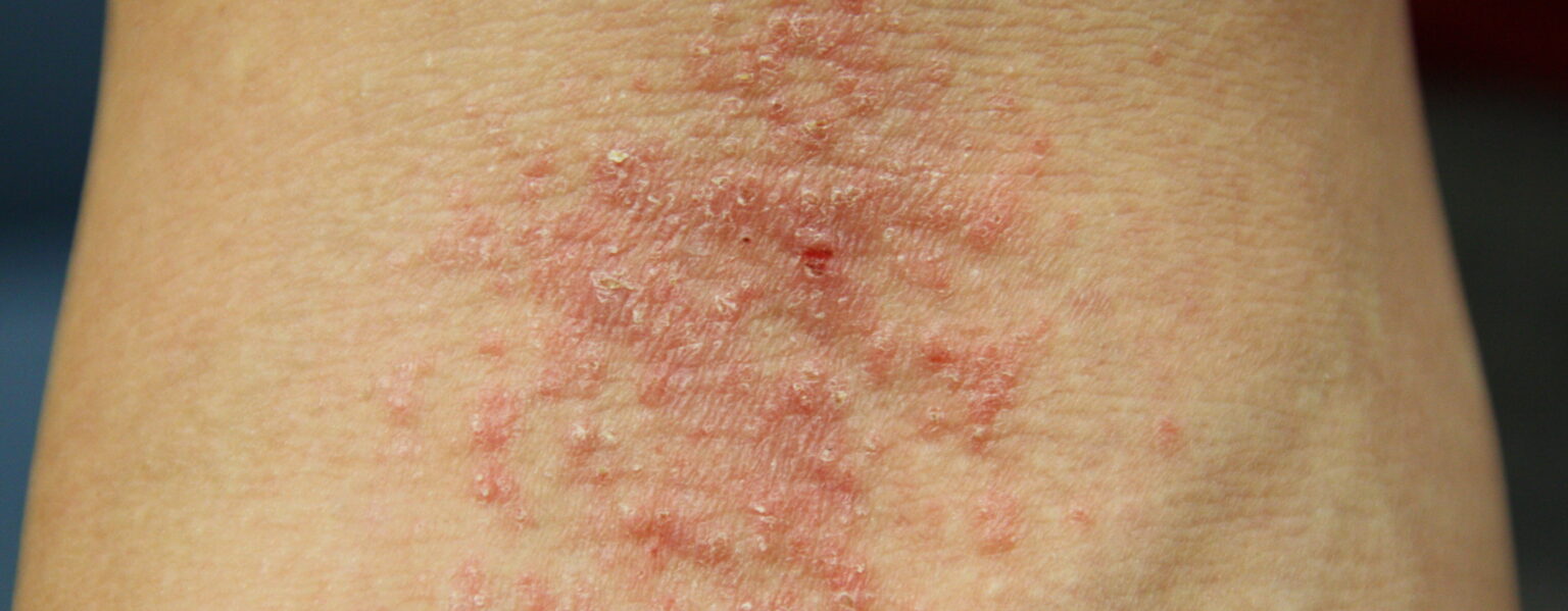 eczema e1447055895810 كيف يمكن علاج الأكزيما بطريقة طبيعية مجلة نقطة العلمية