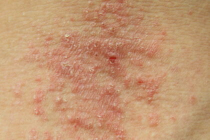 eczema e1447055895810 كيف يمكن علاج الأكزيما بطريقة طبيعية مجلة نقطة العلمية