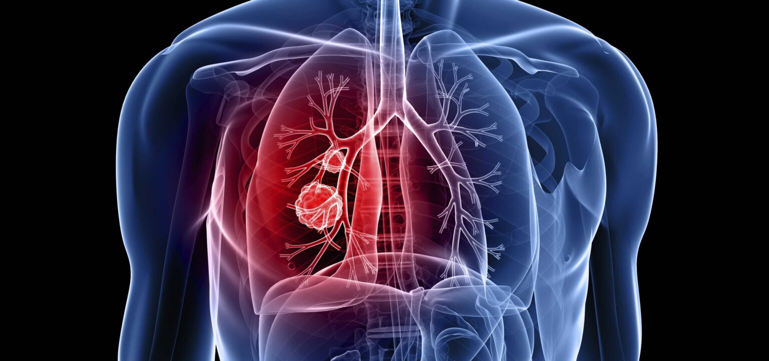 lung cancer e1451985792543 الخلايا السرطانية يمكن أن تسمم الخلايا الطبيعية مجلة نقطة العلمية