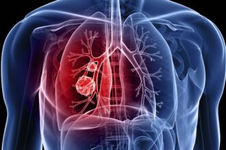 lung cancer e1451985792543 الخلايا السرطانية يمكن أن تسمم الخلايا الطبيعية مجلة نقطة العلمية