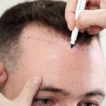 e 45 الرجال هم الأكثر إقبالا على عملية زراعة الشعر مجلة نقطة العلمية