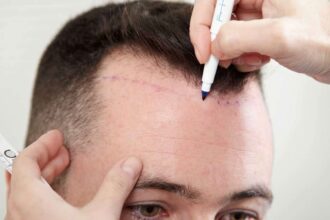 e 45 الرجال هم الأكثر إقبالا على عملية زراعة الشعر مجلة نقطة العلمية