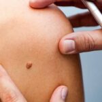 1 8 e1529665006308 ما هي العلامات المميزة لمرض سرطان الجلد؟ مجلة نقطة العلمية