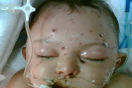 Image046 الاندفاعات حصبية الشكل ( الطفح حصبي الشكل ) مجلة نقطة العلمية