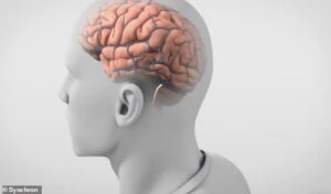 46001559 9835237 The implant is entirely internal Synchron said with no wires com a 3 1627485375075 "Stentrode" شريحة دماغية تعيد الأمل لمرضى الشلل مجلة نقطة العلمية