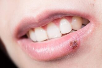 Cold Sore 777x518 1 ماهي العلاقة بين الهربس البسيط (القروح الباردة) والأمراض العصبية التنكسية؟ مجلة نقطة العلمية