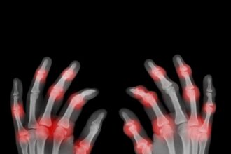 ray of painful hands royalty free image 1602258529 من حالات المناعة الذاتية إلى العدوى إليك سبب شعورك بآلام المفاصل! مجلة نقطة العلمية