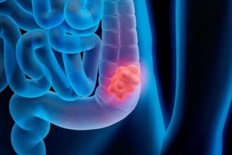 health colon cancer colonoscopy young 02 gty llr 210126 1643239897808 hpMain 16x9 992 ماهي أسباب ارتفاع معدلات إصابة الشباب بسرطان القولون؟ مجلة نقطة العلمية