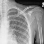 5d2b42b896e3a8aff8c2b53000368f jumbo ما الذي يجب أن تعرفه عن ساركوما العظام (Sarcoma of Bone) مجلة نقطة العلمية