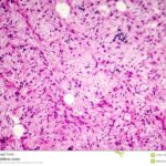 liposarcoma soft tissue sarcoma light micrograph photo under microscope liposarcoma soft tissue sarcoma 123911547 ساركوما الأنسجة الرخوة (Soft Tissue Sarcoma) مجلة نقطة العلمية