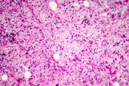 liposarcoma soft tissue sarcoma light micrograph photo under microscope liposarcoma soft tissue sarcoma 123911547 ساركوما الأنسجة الرخوة (Soft Tissue Sarcoma) مجلة نقطة العلمية